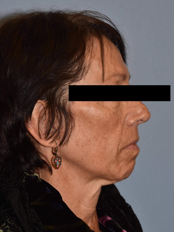 Facelift Before & After Gallery - Patient 420603 - Image 3