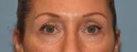Eyelid Lift Before & After Gallery - Patient 832217 - Image 1