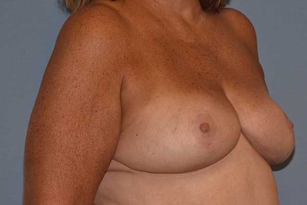 Breast Reduction Before & After Gallery - Patient 250930 - Image 4