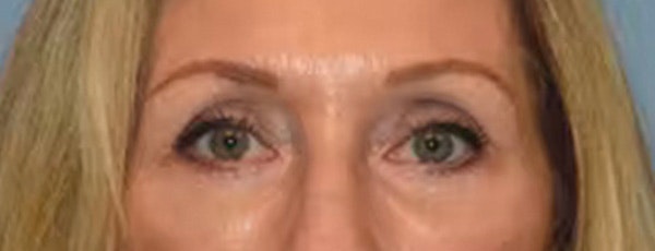 Eyelid Lift Before & After Gallery - Patient 832217 - Image 2