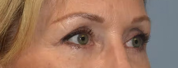 Eyelid Lift Before & After Gallery - Patient 832217 - Image 4