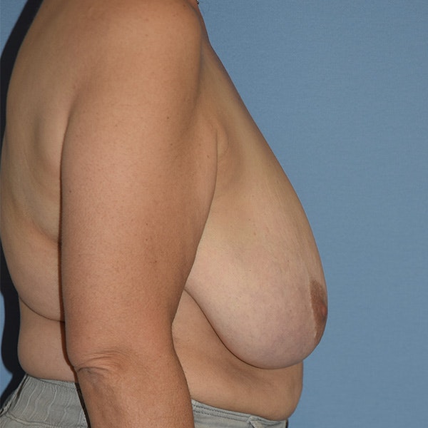Breast Reduction Before & After Gallery - Patient 417811 - Image 3