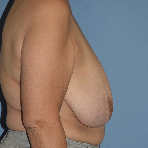 Breast Reduction Before & After Gallery - Patient 417811 - Image 3