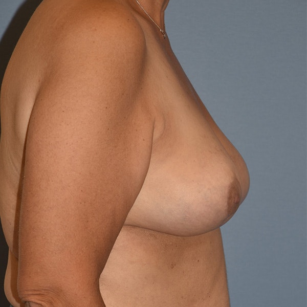 Breast Reduction Before & After Gallery - Patient 417811 - Image 4