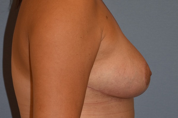 Breast Reduction Before & After Gallery - Patient 213974 - Image 6
