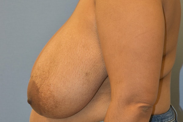 Breast Reduction Before & After Gallery - Patient 152600 - Image 5