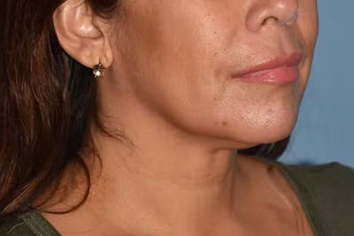 Facelift Before & After Gallery - Patient 281182 - Image 1