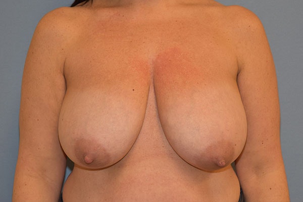 Breast Reduction Before & After Gallery - Patient 415474 - Image 1