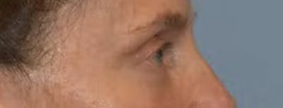 Eyelid Lift Before & After Gallery - Patient 139225 - Image 6