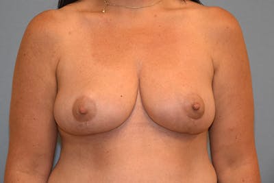 Breast Reduction Before & After Gallery - Patient 415474 - Image 2