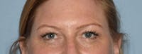 Eyelid Lift Before & After Gallery - Patient 295054 - Image 1