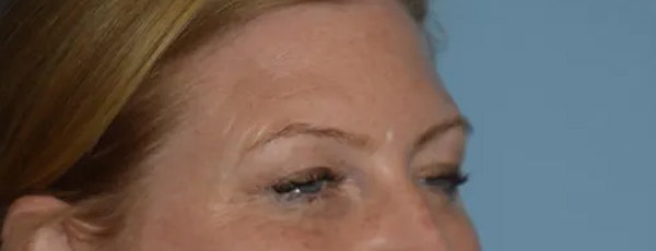 Eyelid Lift Before & After Gallery - Patient 295054 - Image 3