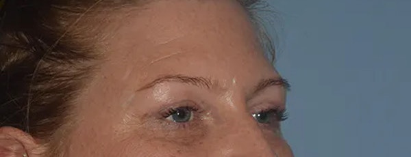Eyelid Lift Before & After Gallery - Patient 295054 - Image 4