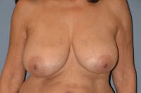 Breast Reduction Before & After Gallery - Patient 991627 - Image 1