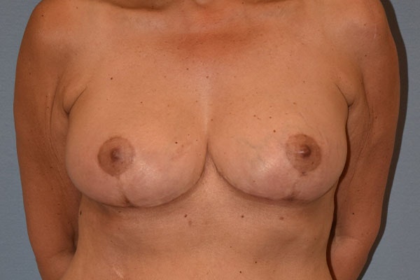 Breast Reduction Before & After Gallery - Patient 991627 - Image 2