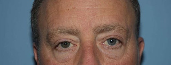 Eyelid Lift Before & After Gallery - Patient 683764 - Image 1