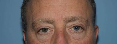 Eyelid Lift Before & After Gallery - Patient 683764 - Image 1