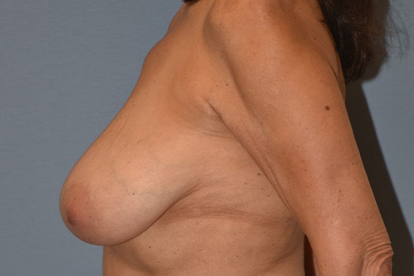 Breast Reduction Before & After Gallery - Patient 991627 - Image 5