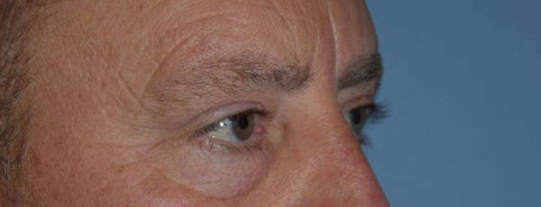 Eyelid Lift Before & After Gallery - Patient 683764 - Image 3