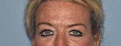Eyelid Lift Before & After Gallery - Patient 400338 - Image 1