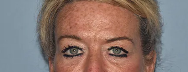 Eyelid Lift Before & After Gallery - Patient 400338 - Image 1