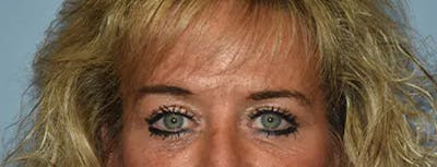 Eyelid Lift Before & After Gallery - Patient 400338 - Image 2