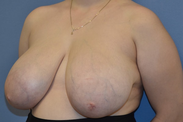 Breast Reduction Before & After Gallery - Patient 411198 - Image 5