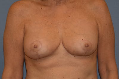 Breast Reduction Before & After Gallery - Patient 301346 - Image 2