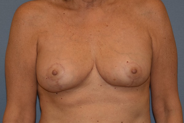 Breast Reduction Before & After Gallery - Patient 301346 - Image 2