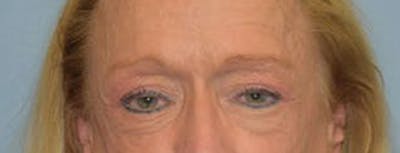 Eyelid Lift Before & After Gallery - Patient 188350 - Image 1