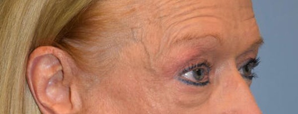 Eyelid Lift Before & After Gallery - Patient 188350 - Image 3