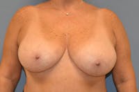 Breast Reduction Before & After Gallery - Patient 328765 - Image 1