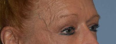 Eyelid Lift Before & After Gallery - Patient 188350 - Image 4