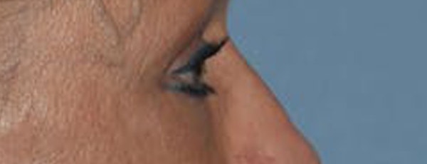 Eyelid Lift Before & After Gallery - Patient 188350 - Image 6