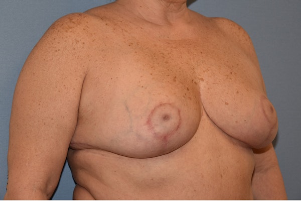 Breast Reduction Before & After Gallery - Patient 328765 - Image 4