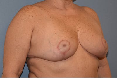 Breast Reduction Before & After Gallery - Patient 328765 - Image 4