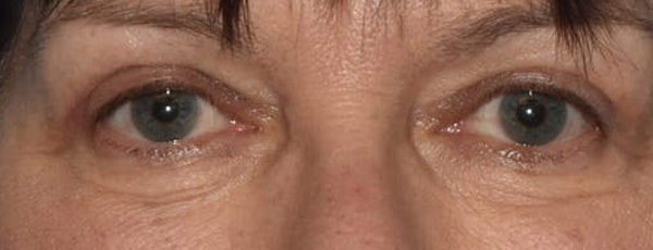 Eyelid Lift Before & After Gallery - Patient 831717 - Image 2
