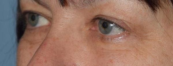 Eyelid Lift Before & After Gallery - Patient 831717 - Image 3