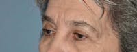Eyelid Lift Before & After Gallery - Patient 223260 - Image 1