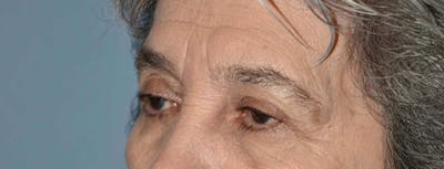 Eyelid Lift Before & After Gallery - Patient 223260 - Image 1