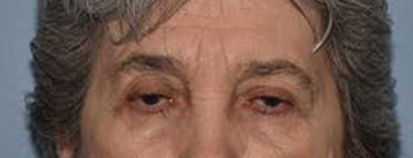Eyelid Lift Before & After Gallery - Patient 223260 - Image 3