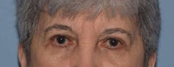 Eyelid Lift Before & After Gallery - Patient 223260 - Image 4