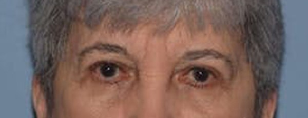 Eyelid Lift Before & After Gallery - Patient 223260 - Image 4