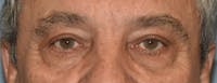 Eyelid Lift Before & After Gallery - Patient 157518 - Image 1