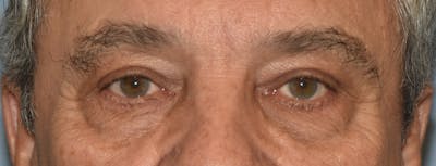 Eyelid Lift Before & After Gallery - Patient 157518 - Image 1