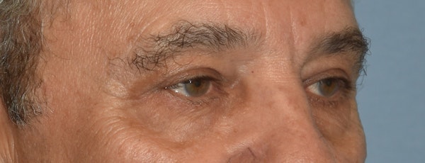 Eyelid Lift Before & After Gallery - Patient 157518 - Image 3