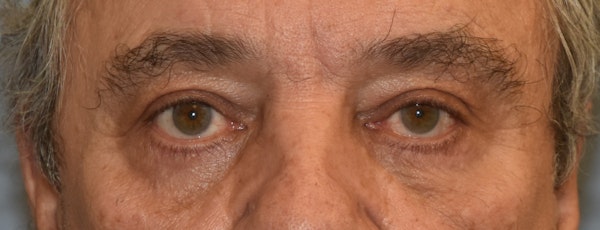 Eyelid Lift Before & After Gallery - Patient 157518 - Image 2