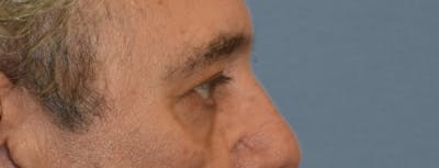 Eyelid Lift Before & After Gallery - Patient 157518 - Image 6