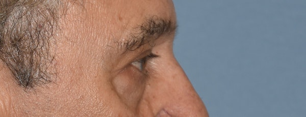 Eyelid Lift Before & After Gallery - Patient 157518 - Image 5