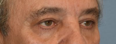 Eyelid Lift Before & After Gallery - Patient 157518 - Image 4